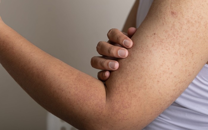 Dày sừng nang lông: Nhận biết và chăm sóc đúng cách - Ảnh 3.
