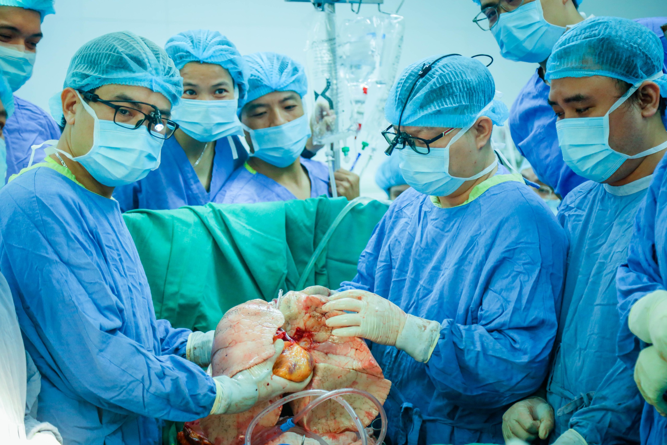 Thêm kỳ tích của ngành y Việt Nam: Lần đầu tiên ghép thành công đồng thời tim - phổi cho người bệnh suy đa tạng- Ảnh 2.