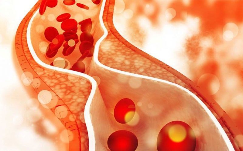 Rối loạn lipid máu ở bệnh nhân tiểu đường cần lưu ý gì?