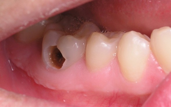 Sâu răng sữa có cần điều trị không?- Ảnh 1. Nhận biết và đề phòng sâu răng ở trẻ