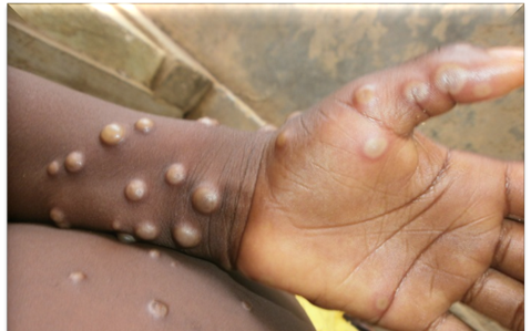 WHO khuyến cáo điều trị HIV sớm cho bệnh nhân đồng nhiễm Mpox