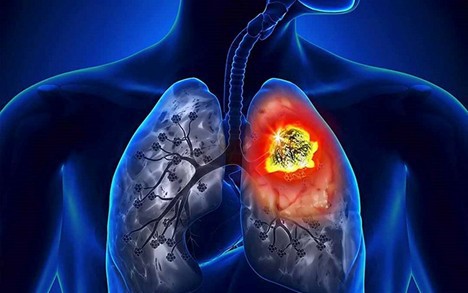 5 bí quyết phòng ngừa ung thư phổi cần biết- Ảnh 2.