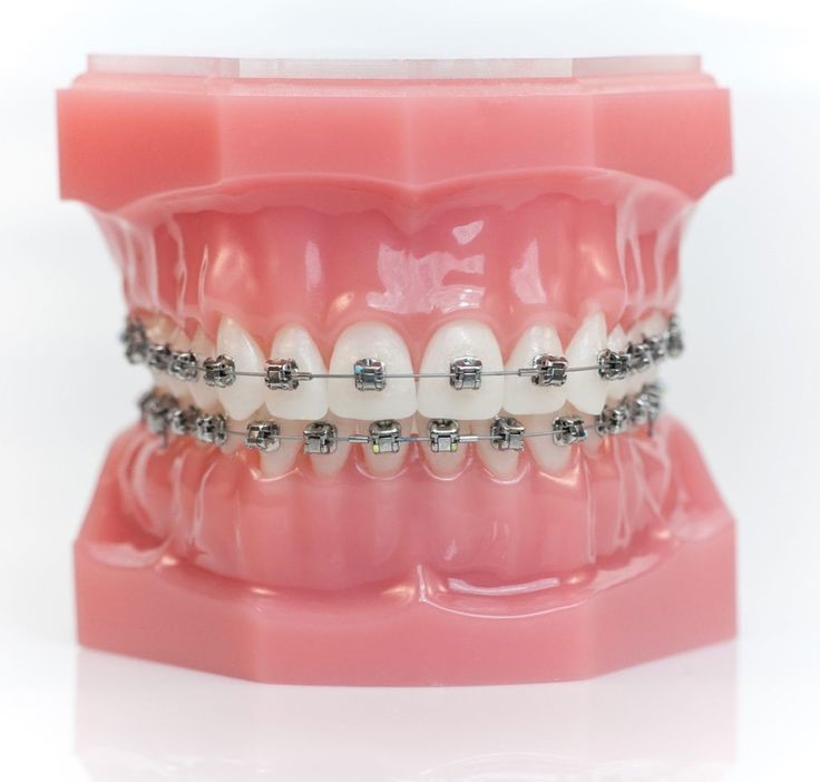 Loại mắc cài nào tốt nhất để niềng răng?- Ảnh 1.
