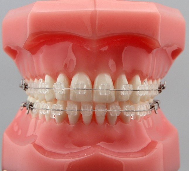 Loại mắc cài nào tốt nhất để niềng răng?- Ảnh 2.