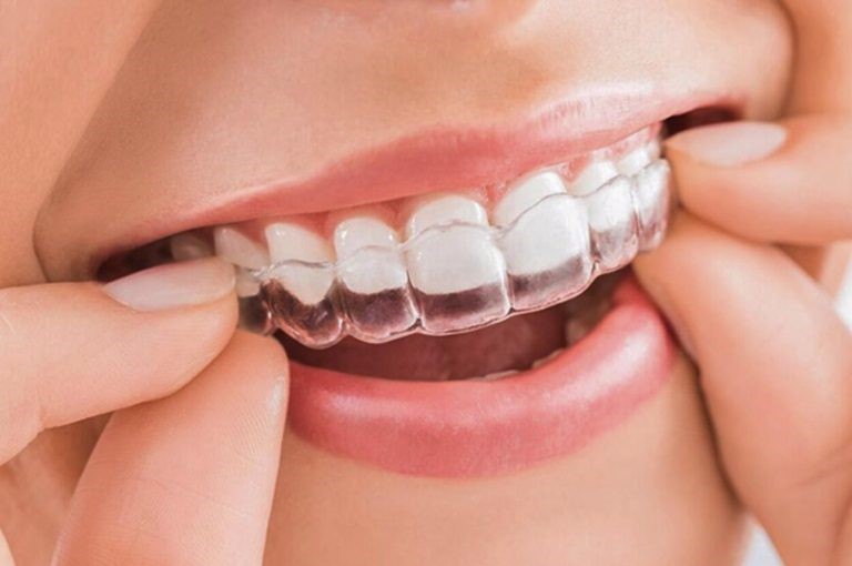Loại mắc cài nào tốt nhất để niềng răng?- Ảnh 3.
