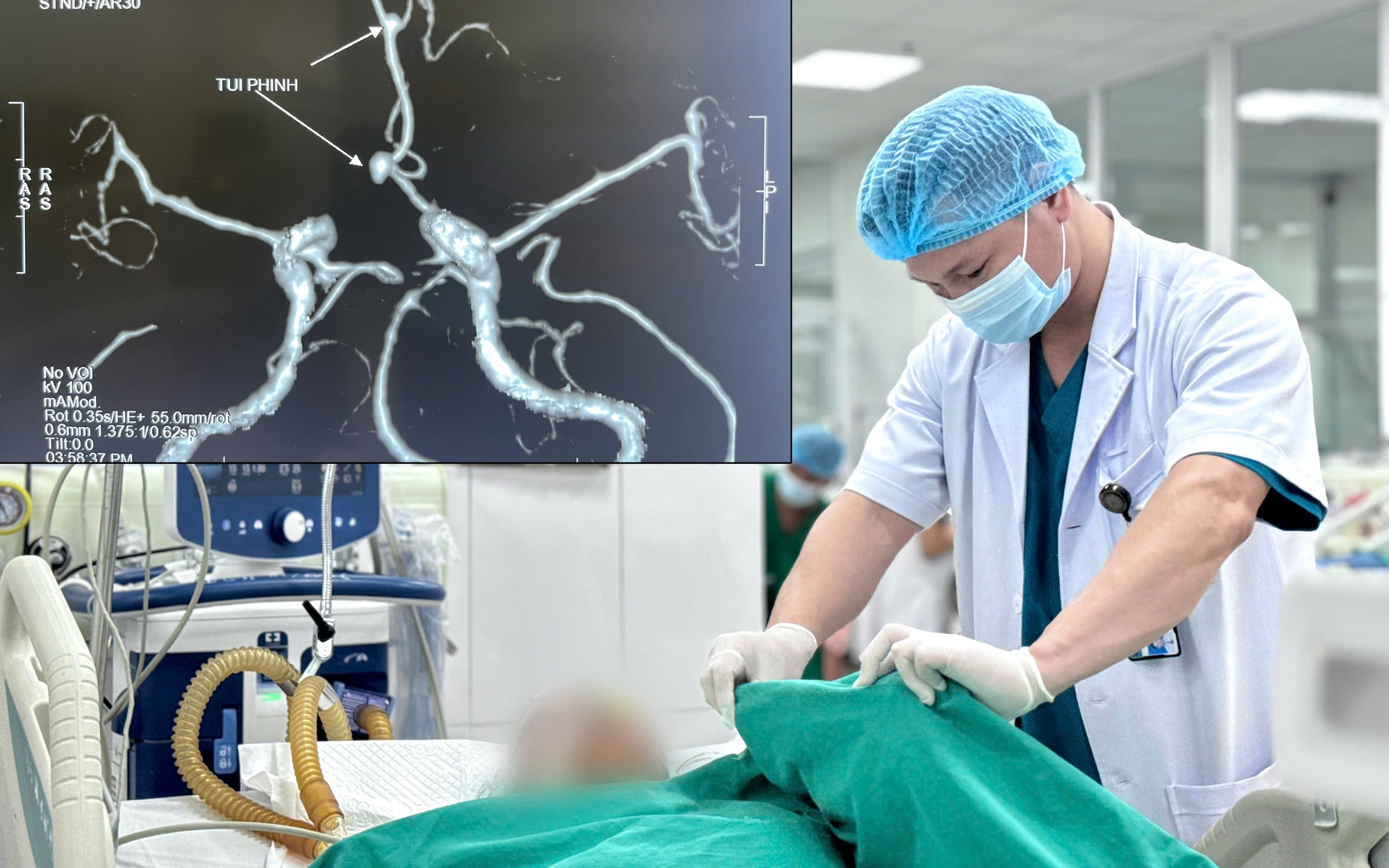 Vi phẫu "thần tốc" cứu sống bệnh nhân vỡ phình động mạch não