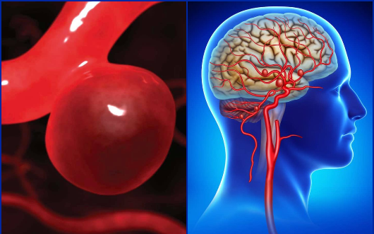 Phình động mạch não có nguy hiểm không?