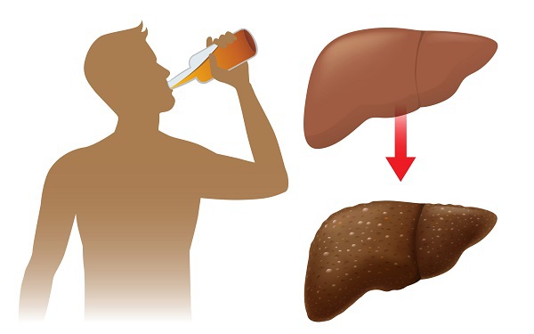 Gan nhiễm mỡ độ I có cần uống thuốc bổ gan không?- Ảnh 3. Gan nhiễm mỡ độ I có cần uống thuốc bổ gan không?- Ảnh 3.