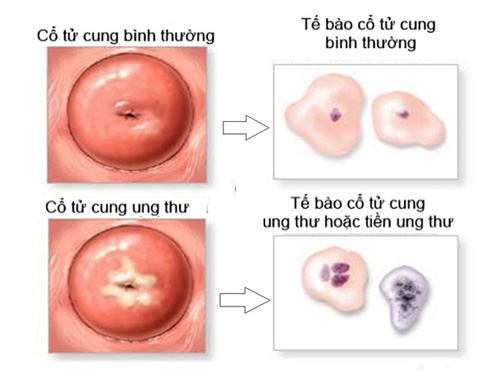 Các xét nghiệm cần thiết giúp sàng lọc ung thư cổ tử cung- Ảnh 2.