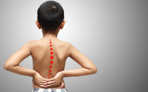 Vì sao cong vẹo cột sống thường gặp ở tuổi dậy thì?- Ảnh 3.