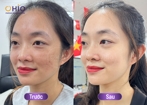 Giãn mao mạch mũi: Nguyên nhân và cách điều trị- Ảnh 3. Giãn mao mạch mũi: Nguyên nhân và cách điều trị- Ảnh 3.