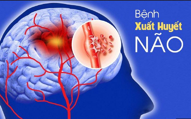 Các loại xuất huyết não và dấu hiệu nhận biết