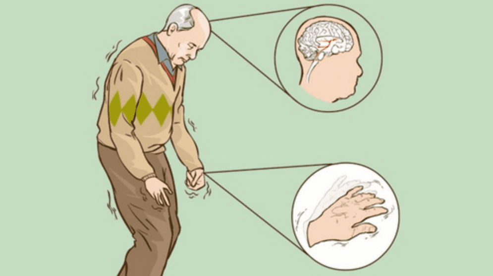 Biểu hiện cho thấy bạn mắc bệnh Parkinson- Ảnh 1.