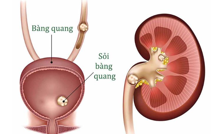 Phẫu thuật khối sỏi bàng quang kích thước lớn cho bệnh nhân mắc nhiều bệnh lý nền- Ảnh 2.