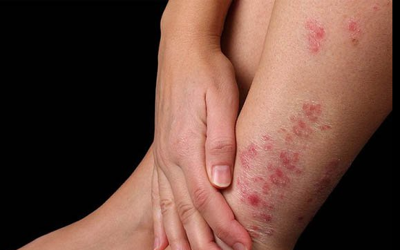 Phát hiện sớm bệnh ngoài da mùa mưa lũ