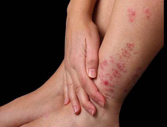 Phát hiện sớm bệnh ngoài da mùa mưa lũ- Ảnh 1. Phát hiện sớm bệnh ngoài da mùa mưa lũ- Ảnh 1.