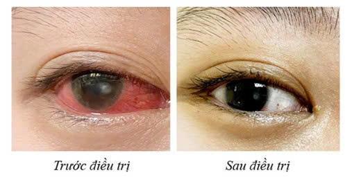 Cô gái bị loét giác mạc vì đeo kính áp tròng thay kính thường ròng rã- Ảnh 2. Cô gái bị loét giác mạc vì đeo kính áp tròng thay kính thường ròng rã- Ảnh 2.
