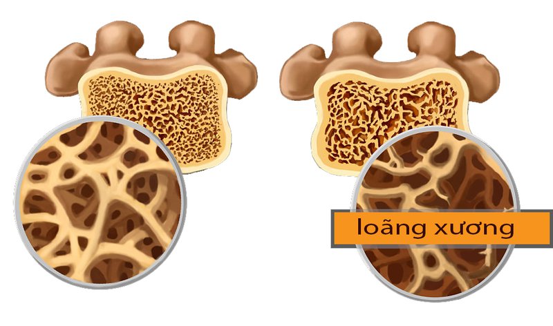 Loãng xương: Dự phòng và điều trị từ lối sống đến thuốc- Ảnh 1. Loãng xương: Dự phòng và điều trị từ lối sống đến thuốc- Ảnh 1.