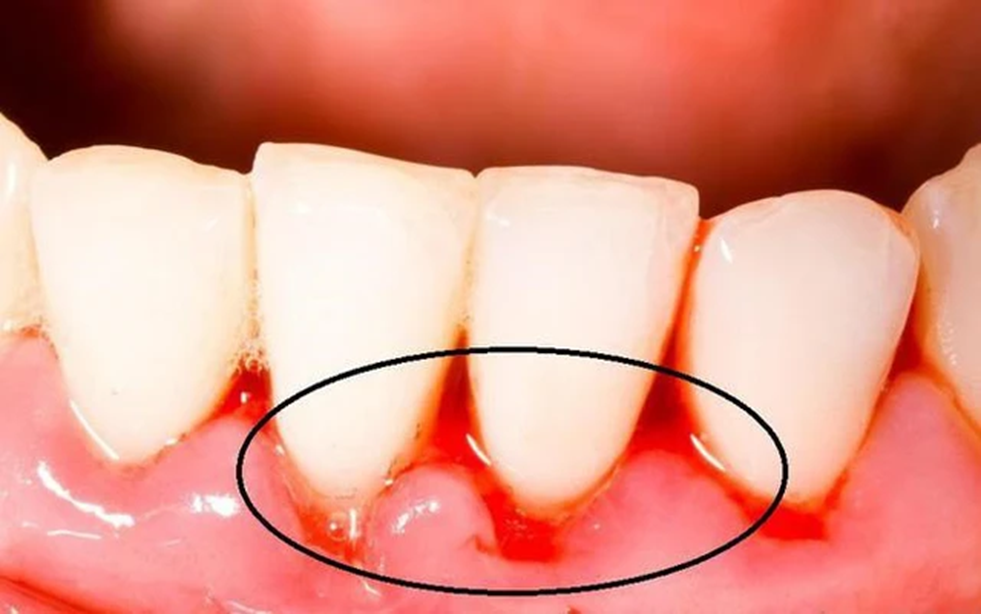 Chảy máu chân răng – Cơ thể cảnh báo điều gì?- Ảnh 1. Chảy máu chân răng – Cơ thể cảnh báo điều gì?- Ảnh 1.