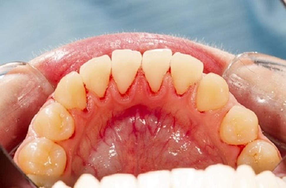 Chảy máu chân răng – Cơ thể cảnh báo điều gì?- Ảnh 2. Chảy máu chân răng – Cơ thể cảnh báo điều gì?- Ảnh 2.