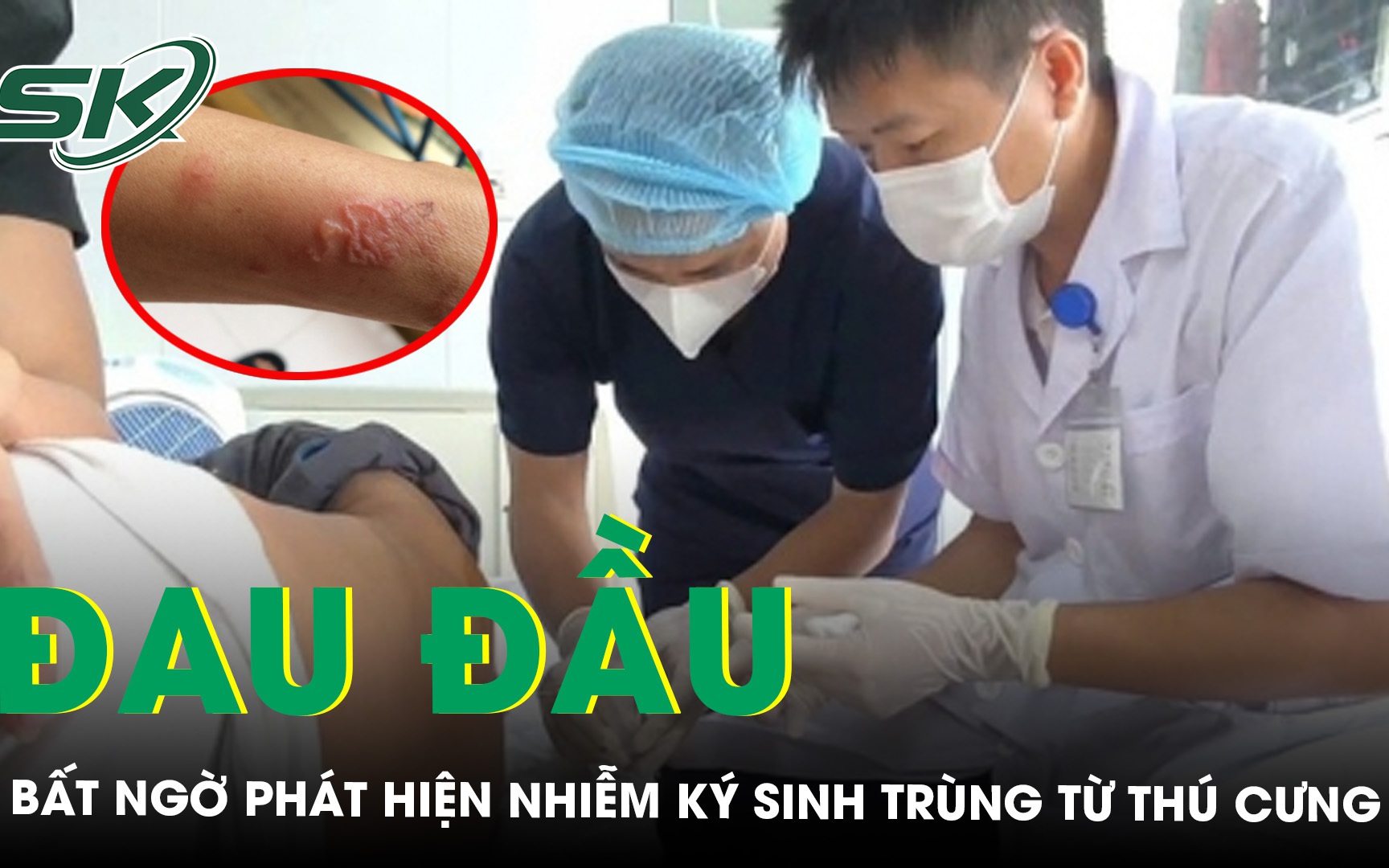 Phẫu thuật khối u, phát hiện ký sinh trùng dạng sán trong vùng hố chậu bệnh nhân- Ảnh 2. Phẫu thuật khối u, phát hiện ký sinh trùng dạng sán trong vùng hố chậu bệnh nhân- Ảnh 2.