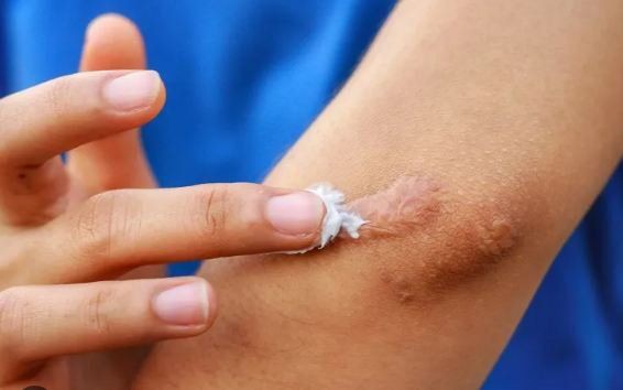 Bộ Y tế đình chỉ, thu hồi toàn quốc, yêu cầu tiêu hủy 1 loại gel "ngừa sẹo" do vi phạm 3 lỗi