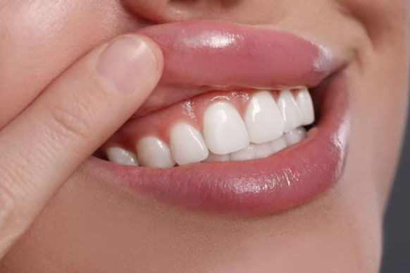Bỏ quên khe nướu (lợi) - lý do đau răng, viêm nướu (lợi) kéo dài- Ảnh 2. Bỏ quên khe nướu (lợi) - lý do đau răng, viêm nướu (lợi) kéo dài- Ảnh 2.
