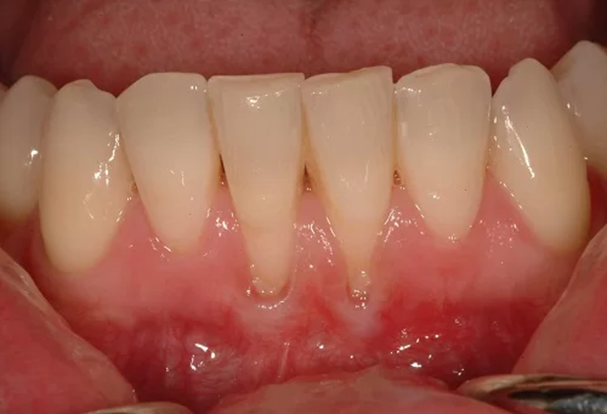 Tụt nướu ‘không phanh’: Phục hồi nướu (lợi) thẩm mỹ, lấy lại nụ cười rạng ngời- Ảnh 1. Tụt nướu ‘không phanh’: Phục hồi nướu (lợi) thẩm mỹ, lấy lại nụ cười rạng ngời- Ảnh 1.