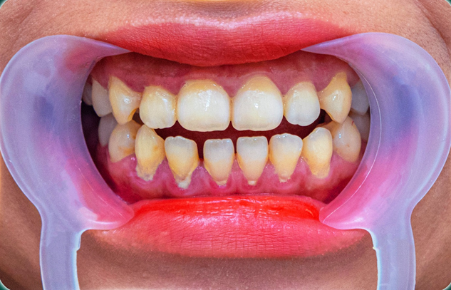 Tụt nướu ‘không phanh’: Phục hồi nướu (lợi) thẩm mỹ, lấy lại nụ cười rạng ngời- Ảnh 2. Tụt nướu ‘không phanh’: Phục hồi nướu (lợi) thẩm mỹ, lấy lại nụ cười rạng ngời- Ảnh 2.
