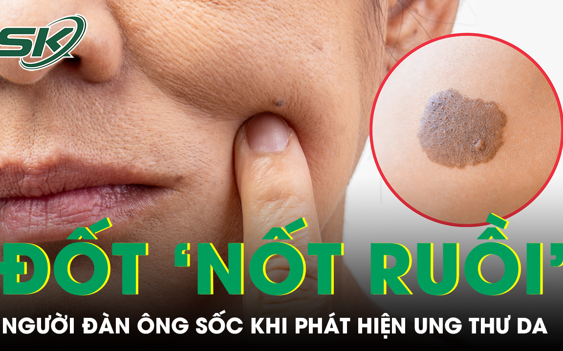 Liên tục đốt ‘nốt ruồi’ không hết, người đàn ông trẻ sốc khi phát hiện mắc ung thư da