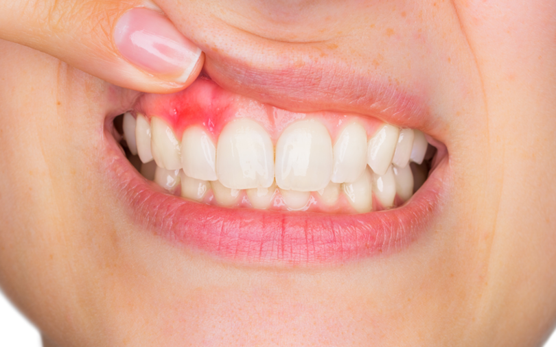 Có thể bạn chưa biết: Răng miệng khỏe - phòng bệnh toàn thân- Ảnh 2.