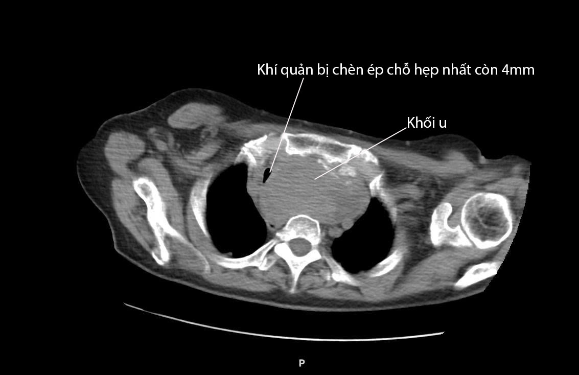 Suýt mất mạng vì chủ quan với bướu giáp lành tính- Ảnh 1. Suýt mất mạng vì chủ quan với bướu giáp lành tính- Ảnh 1.
