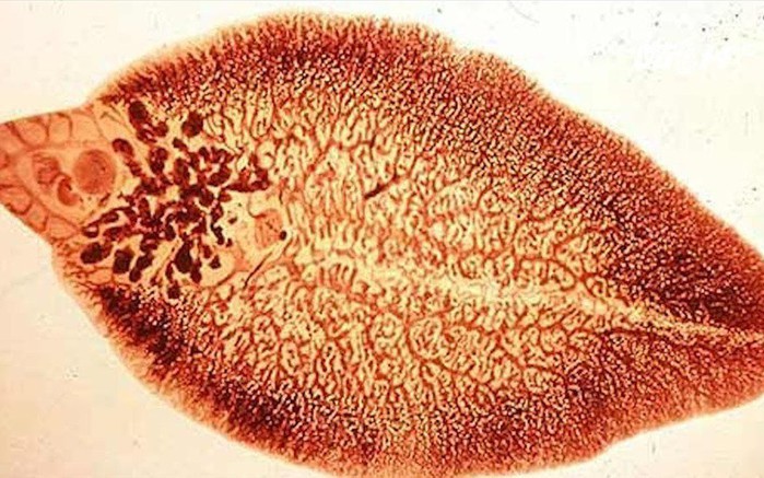 Tưởng đau dạ dày hóa ra nhiễm sán lá gan lớn