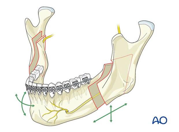 Điều trị móm (khớp cắn ngược) do xương hàm- Ảnh 5. Điều trị móm (khớp cắn ngược) do xương hàm- Ảnh 5.