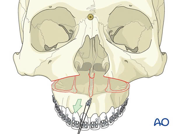 Điều trị móm (khớp cắn ngược) do xương hàm- Ảnh 4. Điều trị móm (khớp cắn ngược) do xương hàm- Ảnh 4.