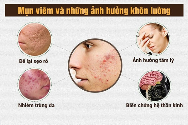 Dùng thuốc và cách chăm sóc da mụn viêm đỏ tại nhà- Ảnh 3.