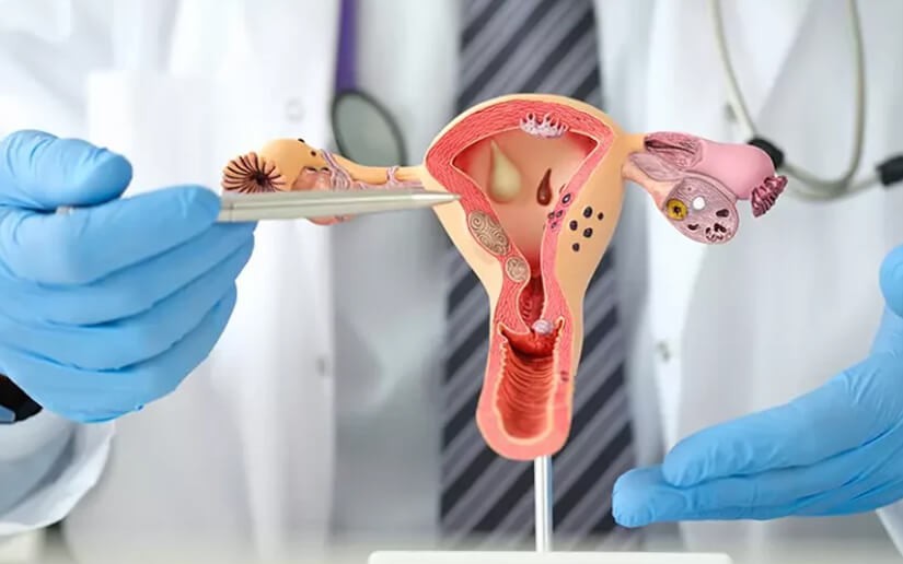 Nguyên nhân gây buồng trứng đa nang