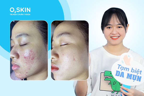 Cá nhân hóa phác đồ điều trị mụn trứng cá và những lưu ý khi áp dụng- Ảnh 2.