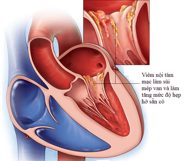 Triệu chứng viêm nội tâm mạc nhiễm trùng- Ảnh 1. Triệu chứng viêm nội tâm mạc nhiễm trùng- Ảnh 1.