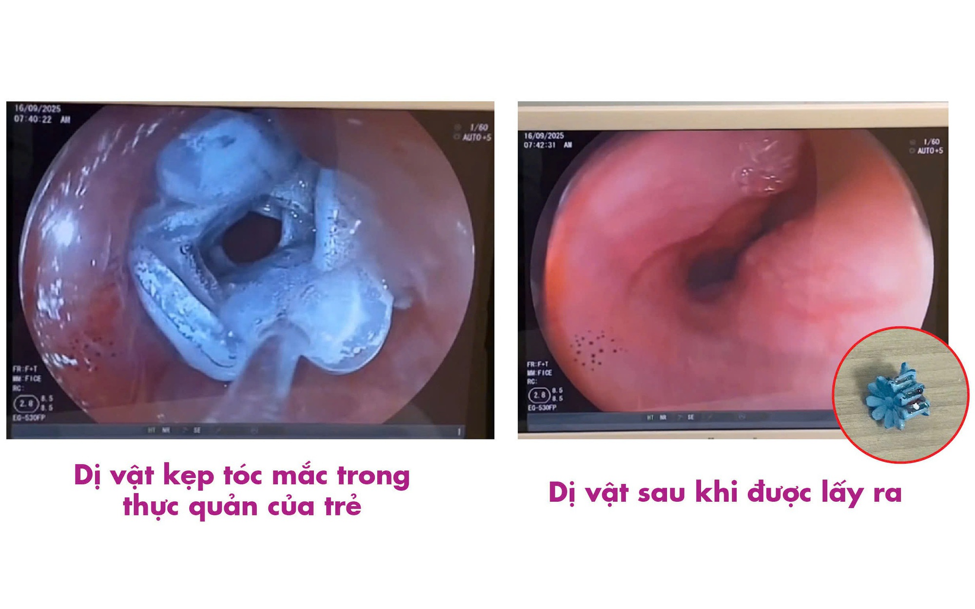 Bất ngờ mắc uốn ván sau khi bị sâu răng- Ảnh 3.