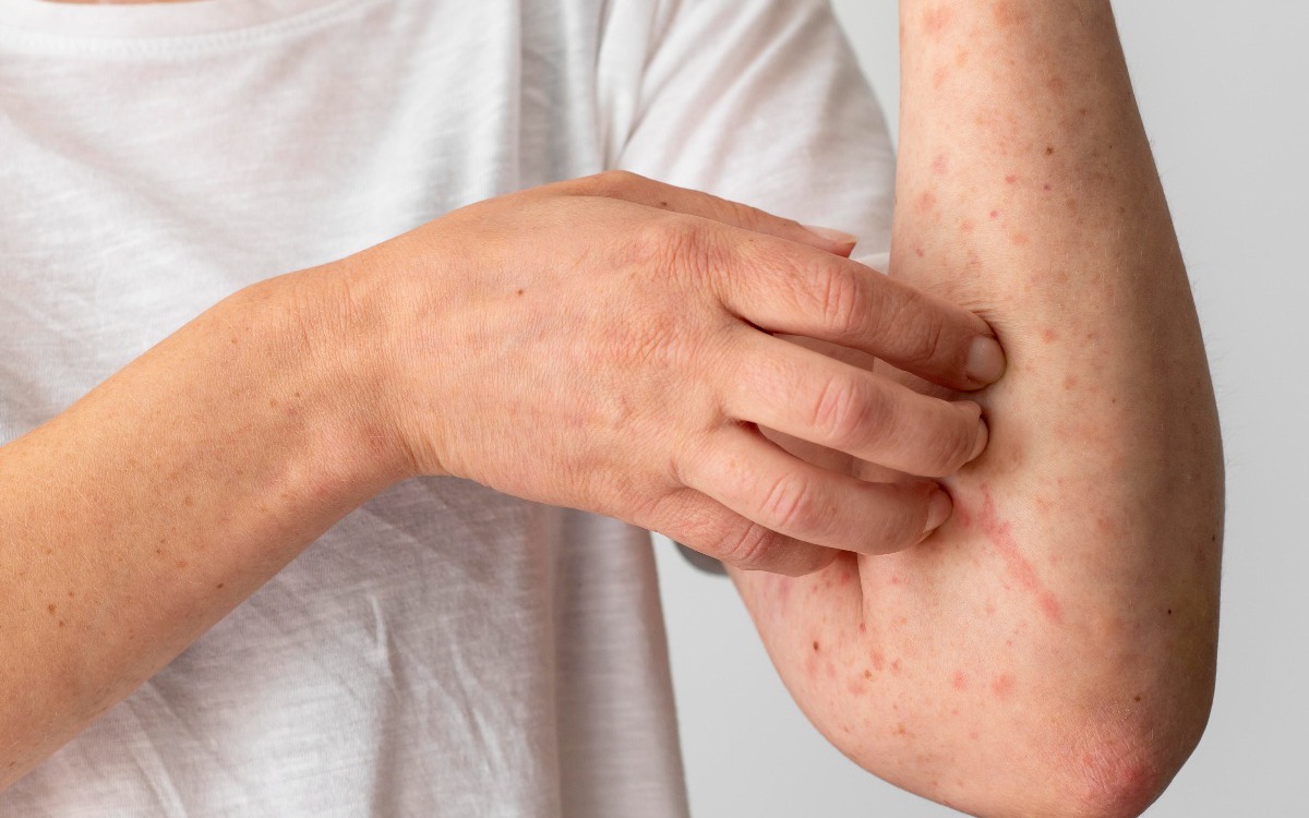 Các biện pháp phòng ngừa viêm da cơ địa 