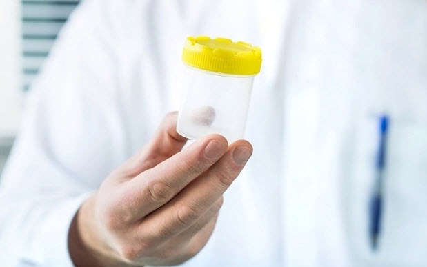 Hormone và tinh trùng nam suy giảm vì bệnh mãn tính