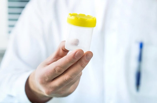 Hormone và tinh trùng nam suy giảm vì bệnh mãn tính- Ảnh 2.
