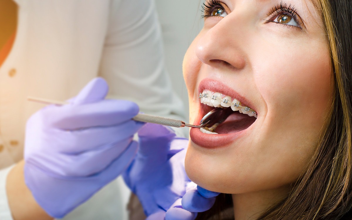 Nên ăn gì khi niềng răng để đảm bảo dinh dưỡng?