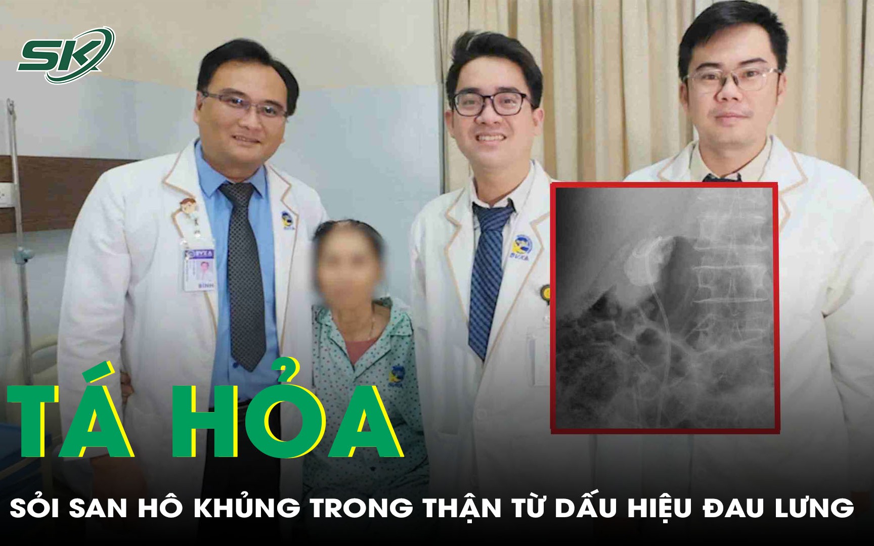 Phẫu thuật thành công ca sỏi san hô phức tạp trên nền xơ gan- Ảnh 4.