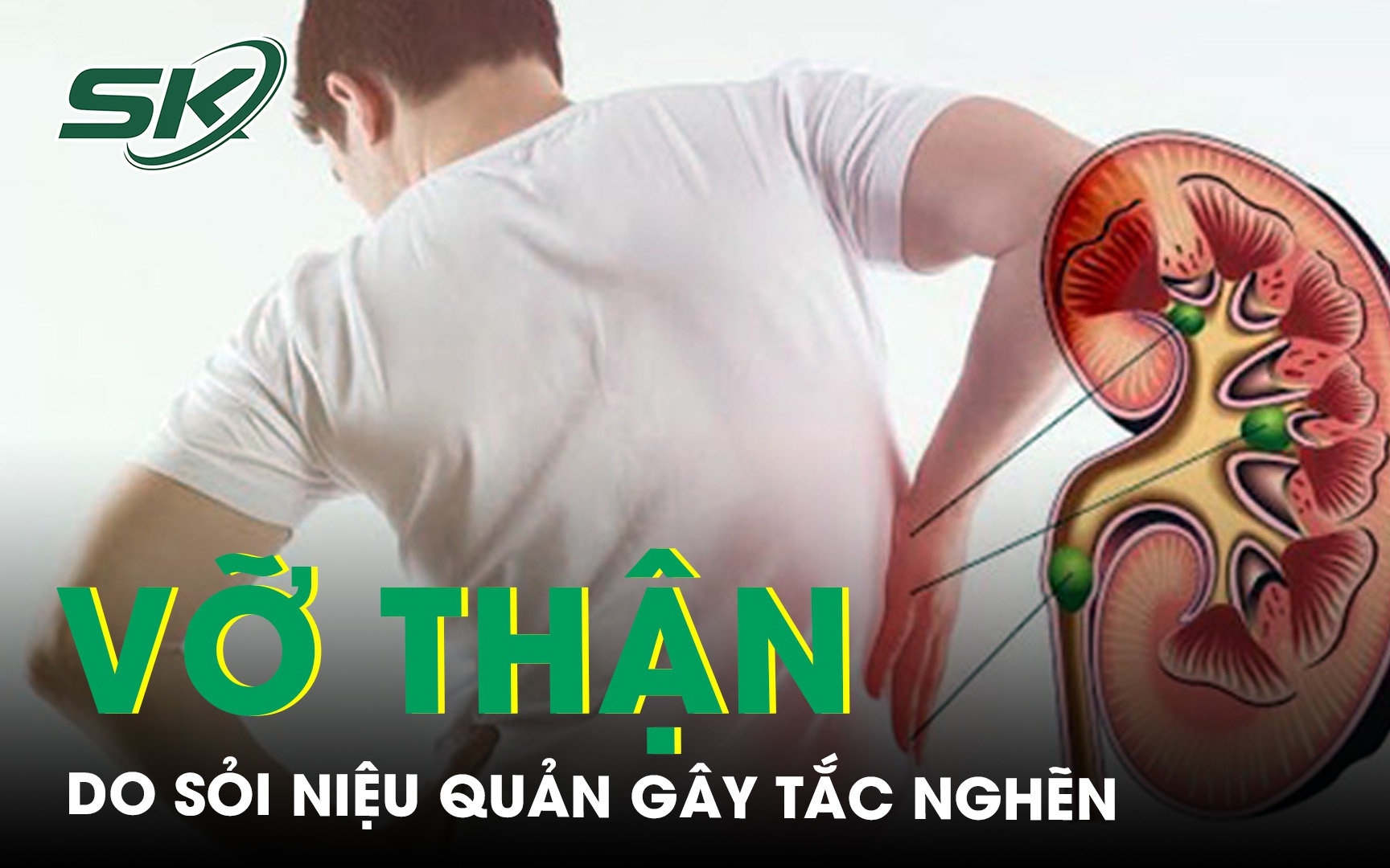Đau lưng hóa ra sỏi niệu quản tắc nghẽn gây vỡ thận