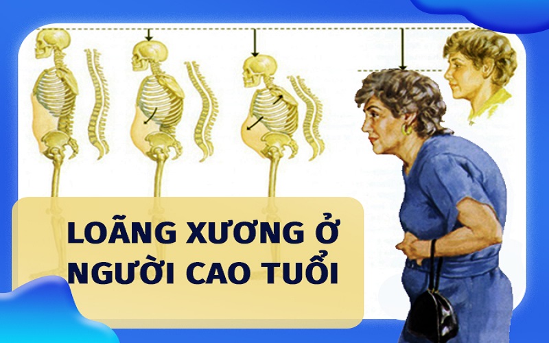 Loãng xương ở người cao tuổi dùng thuốc và chữa như thế nào?- Ảnh 1. Loãng xương ở người cao tuổi dùng thuốc và chữa như thế nào?- Ảnh 1.