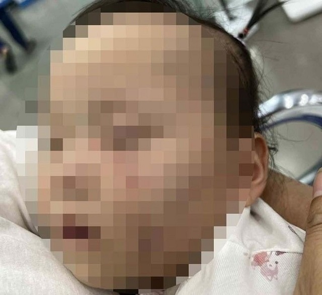Đón con từ nhà trẻ về có nhiều vết bầm tím trên người: Tạm giữ bảo mẫu để điều tra- Ảnh 1. Đón con từ nhà trẻ về có nhiều vết bầm tím trên người: Tạm giữ bảo mẫu để điều tra- Ảnh 1.