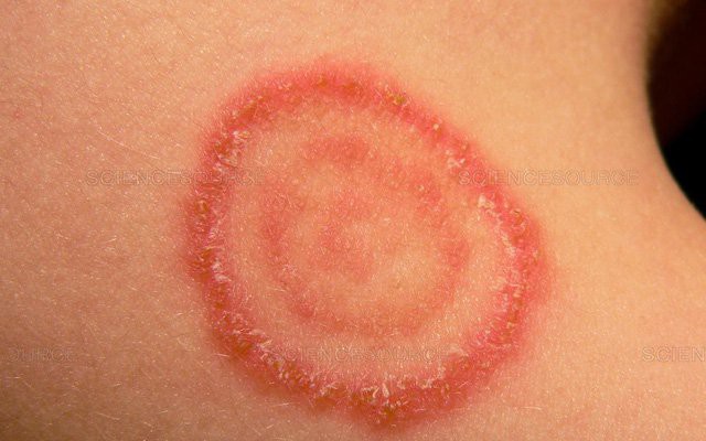 Nhiễm nấm nội tạng đe dọa sức khỏe người già- Ảnh 3.