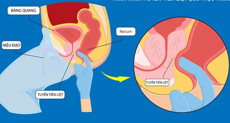 4 biểu hiện của phì đại tuyến tiền liệt nam giới cần biết- Ảnh 1.